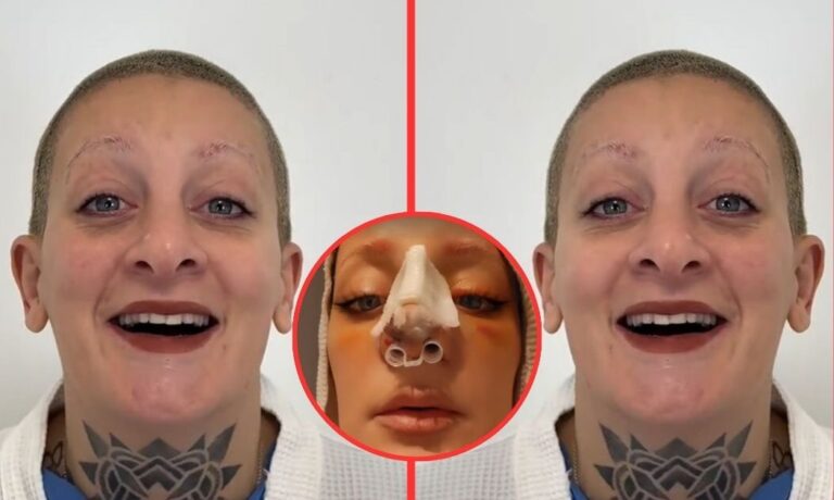 Se operó y así quedó: el antes y después de la nueva nariz de Furia