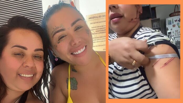 Merly Ome mostrando su rostro con cicatrices tras accidente de moto
