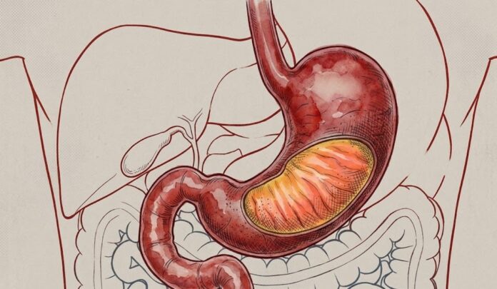 Ilustración de estómago humano con zonas de alerta en rojo sobre fondo neutro