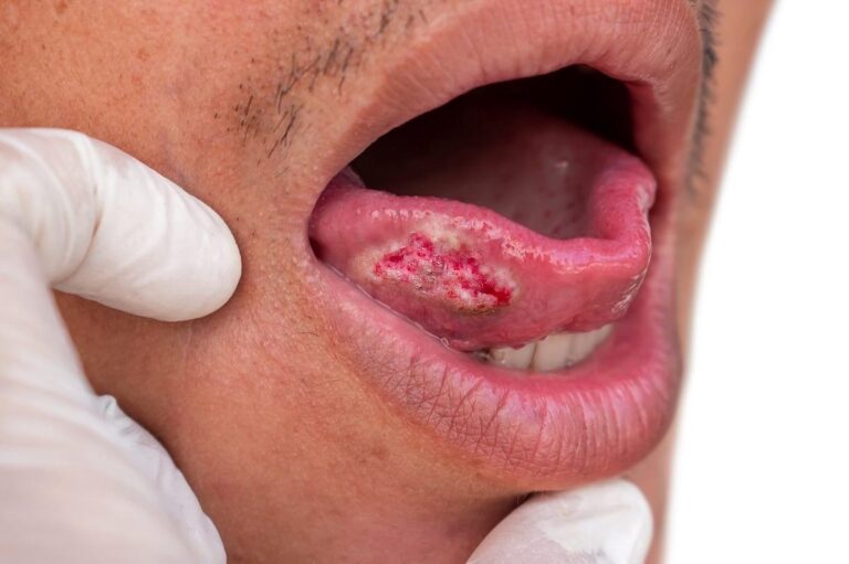 Cepillo redondo utilizado para la prueba de detección de cáncer oral